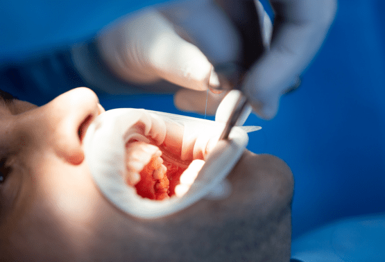 Dental Implants