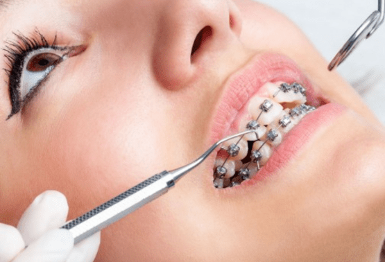 Dental Implants