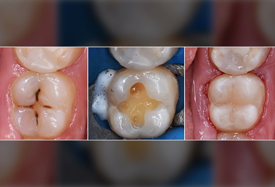 Tooth Filling